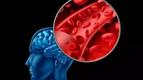 La ciencia confirma v&iacute;nculo entre Alzheimer y trastornos intestinales