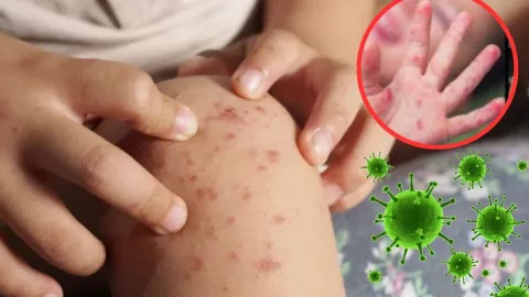 Virus Coxsackie en Veracruz
