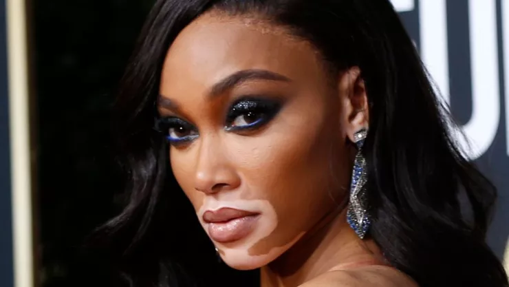vitiligo Winnie Harlow efemérides 25 de junio