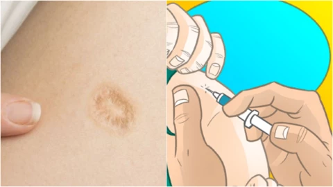 ¿Por qué queda la marca de vacuna en el brazo y qué significa