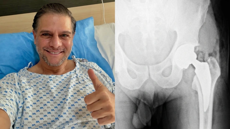 La cirugía de cadera que marcó a Rafa Mercadante: ¿qué le sucedió al actor?