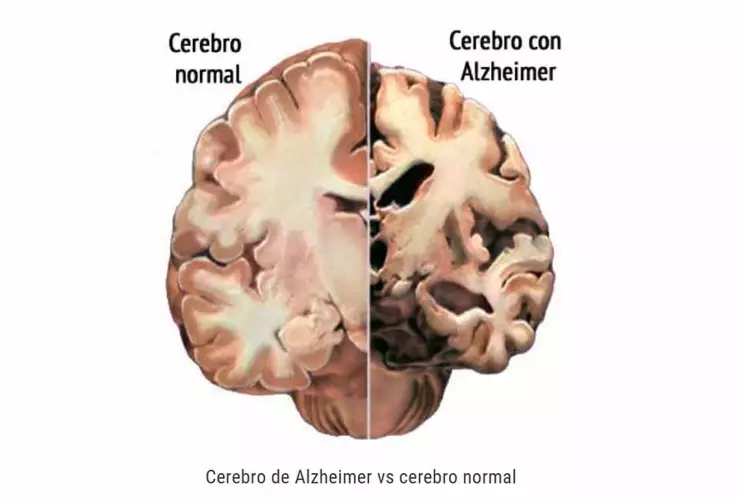 Un cerebro con Alzheimer disminuye su peso y su volumen.