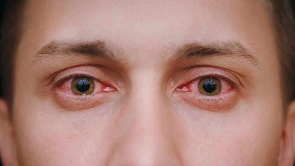 Ojos Rojos