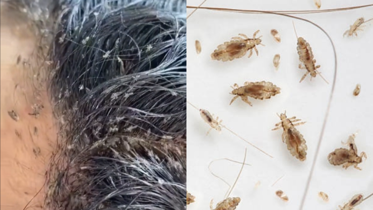 niña con piojos.png