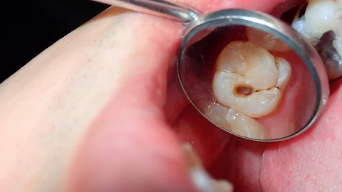 Señales de que un menor podría tener caries dental.