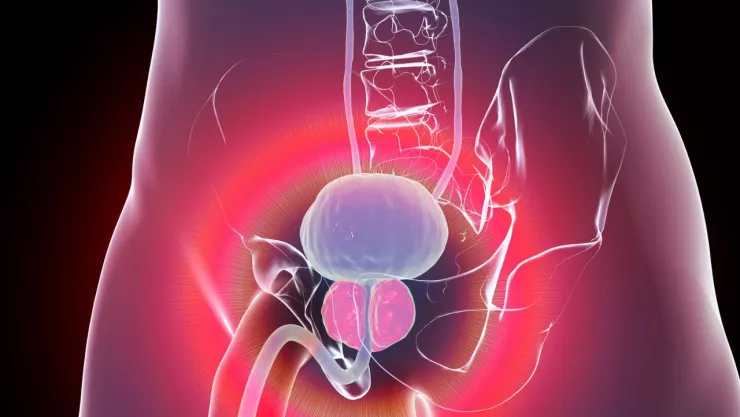 cáncer de próstata, alerta por la orina