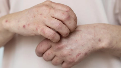 ¡Atención! Casos de Sarampión aumentan en BC, ¿suspenderán clases?