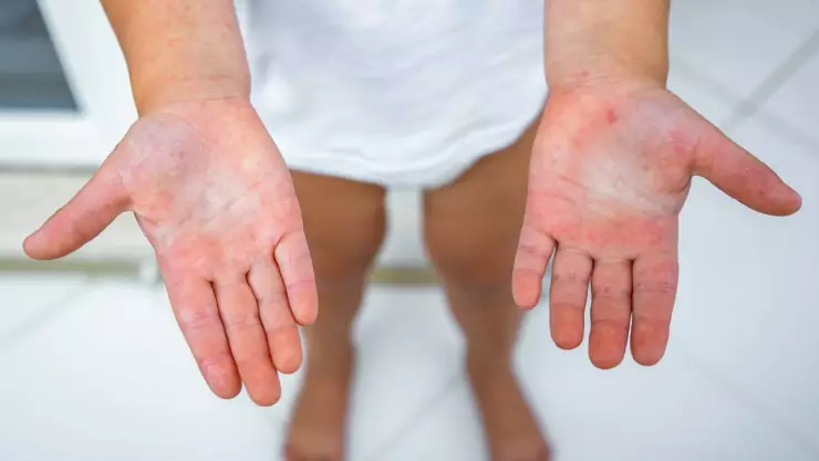 ¿Qué es el virus Coxsackie?