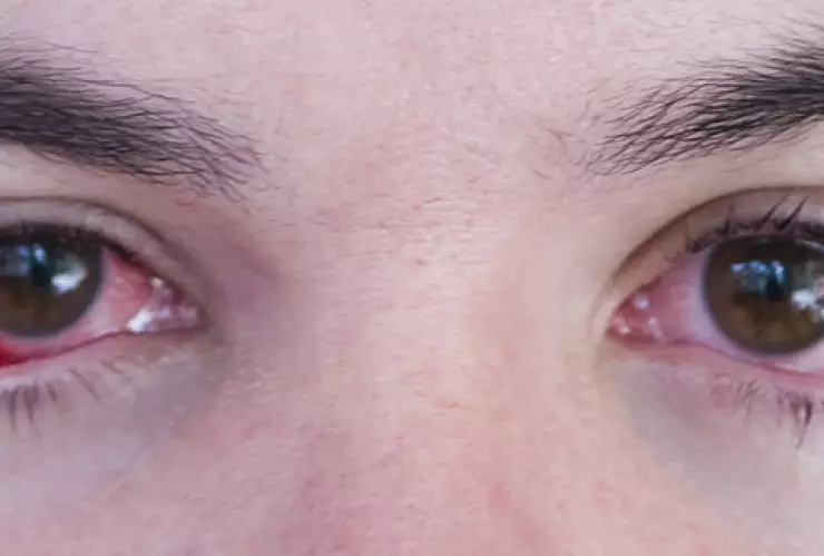 Conjuntivitis Ómicron síntomas 3.jpg
