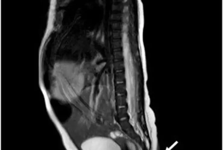 Nace bebé con cola de 6 cm en Nuevo León