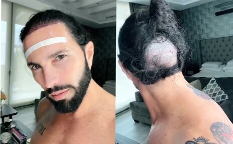 Poncho de Nigris se coloca injerto de cabello