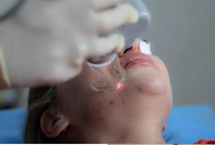 /estilo-de/consecuencias-si-tratas-cicatrices-laser-voz-expertos-pb-notas