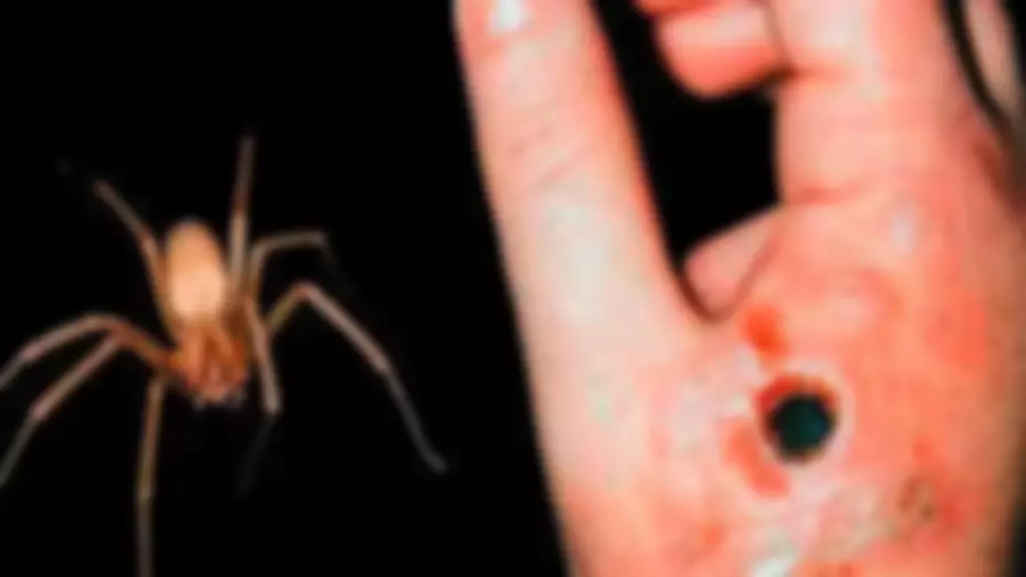 FOTOS_ ¿Cómo se ve la necrosis por mordedura de araña violinista?