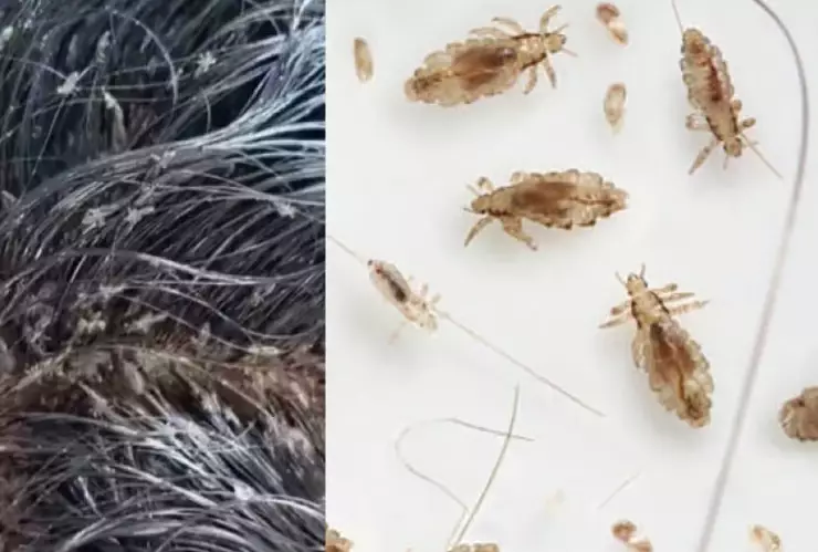 muere por piojos.jpg