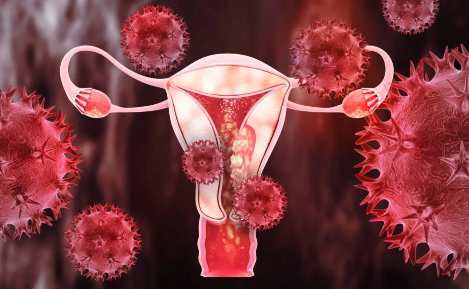 Cáncer de ovario y endometrio.png