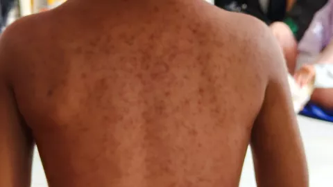 Complicaciones severas y secuelas después de un contagio de sarampión