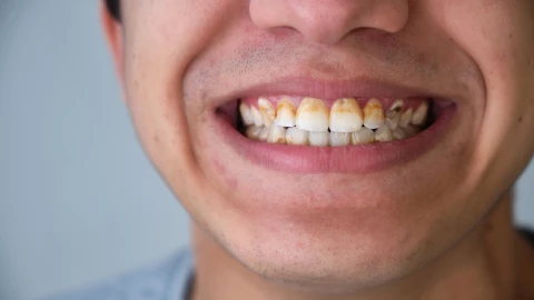 No son caries: Qué son las manchas negras en los dientes y cómo se quitan
