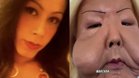 /famosos/influencer-juju-do-pix-termina-cara-desfigurada-recibir-inyecciones-clinica-ilegal-pb-notas