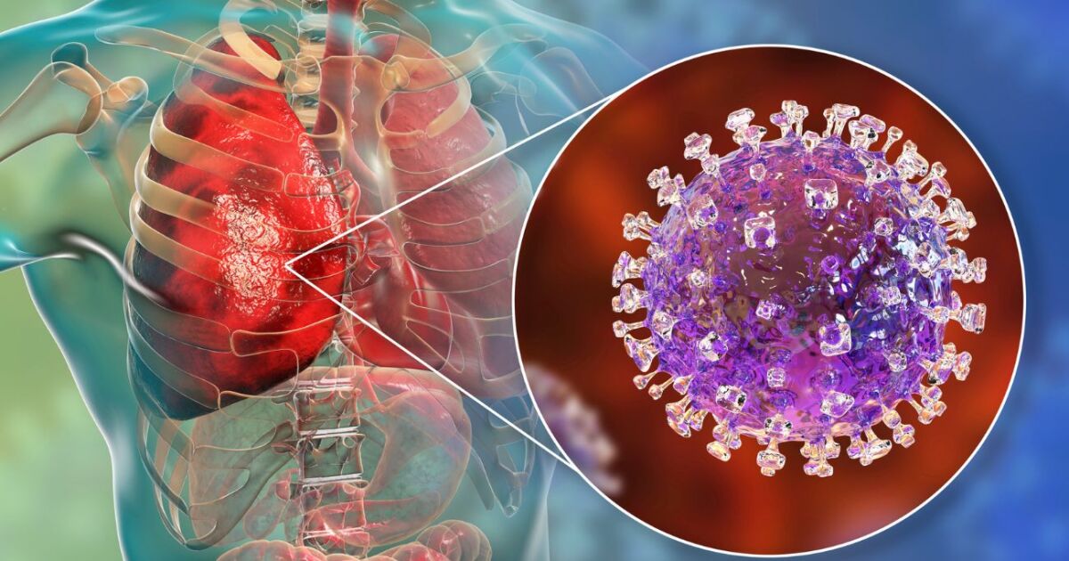 WHO Warns: What is It, Symptoms, and Why Pandemic Surveillance is Needed