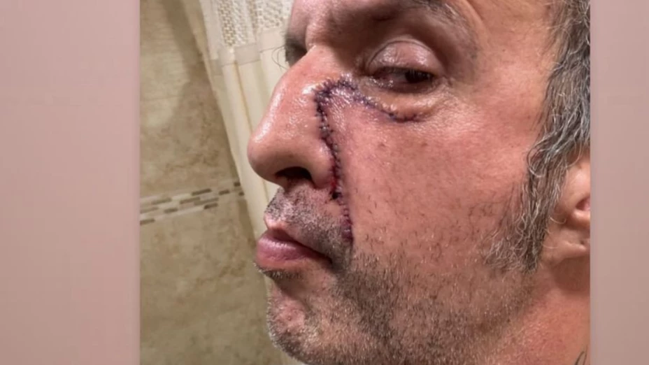 tito fuentes de molotovo revela como quedo su rostro tras cirugia y estar en coma (1).png