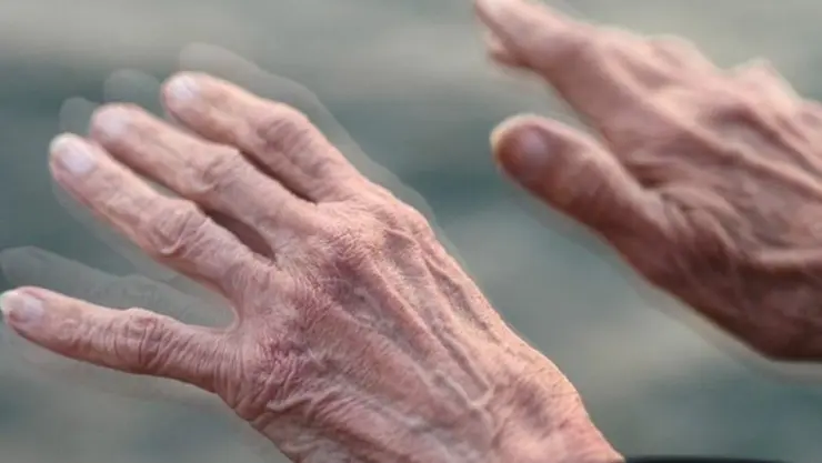 parkinson