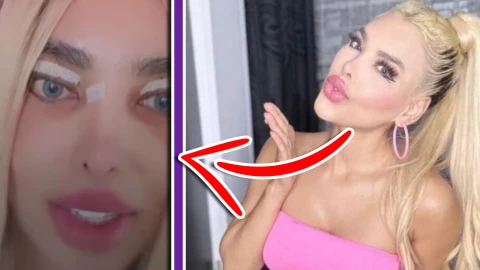 VIDEO_ ¿Qué le pasó a la Barbie Colombiana_ El polémico video donde no puede cerrar los ojos tras cirugía.webp