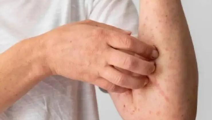 Sarampión en Yucatán: ¿Quiénes deben vacunarse y cómo prevenir la enfermedad?