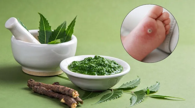 La planta con savia lechosa que promete borrar verrugas y acné según expertos