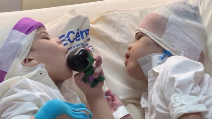 Salud de gemelos brasileños mejora tras la cirugía de separación.