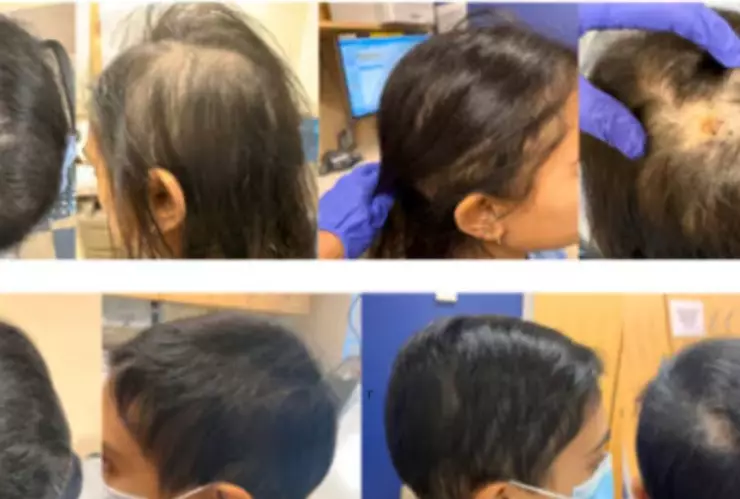 picadura de garrapata hace que mujer pierda su cabello