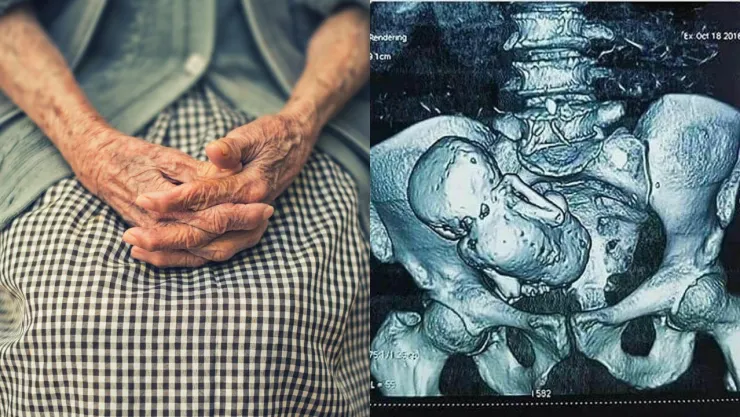 Descubren un feto momificado en una mujer de 84 años de Durango; llevaba 40 años dentro