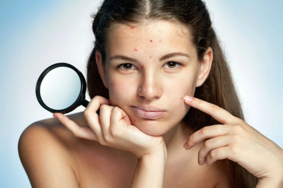 Acne inversa