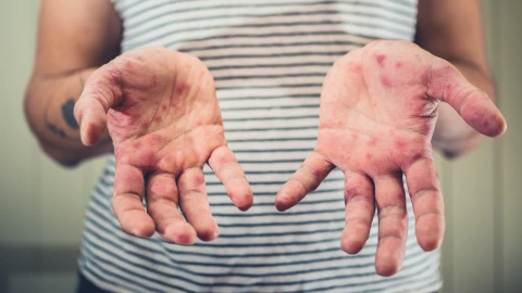 Cuál es la diferencia entre sarampión y varicela.