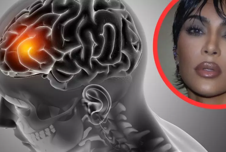 Kim Kardashian informó que fue diagnosticada con un aneurisma cerebral