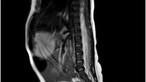 Nace bebé con cola de 6 cm en Nuevo León