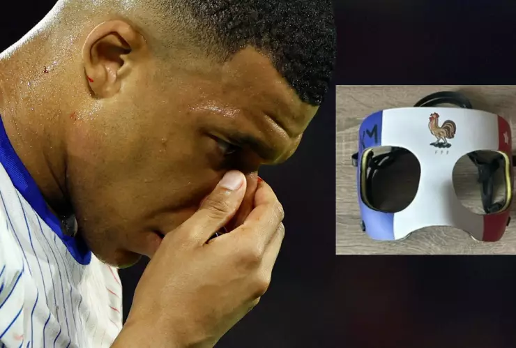 Kylian Mbappé sufrió una lesión en la nariz el 17 de junio.