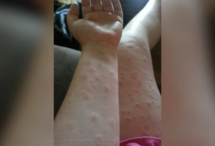 Picadura de chinche cómo se ve, síntomas y qué hacer si encuentras chinches