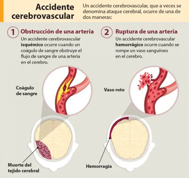 Muerte de Gustavo Cerati: Esto es un accidente cerebro vascular, causa por la que cayó en coma