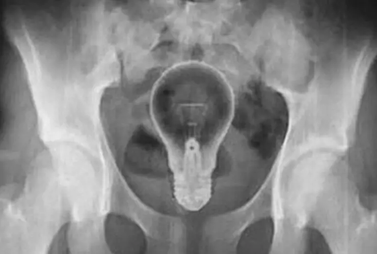 Encuentran un foco atorado en el recto de un hombre