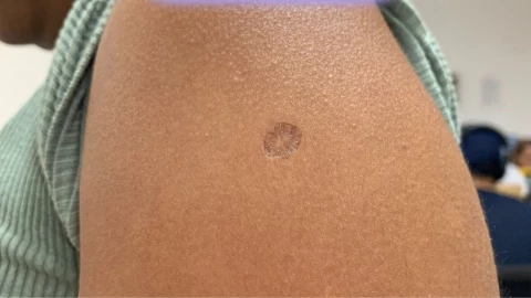 De qué vacuna es la cicatriz que tienes en tu brazo derecho.