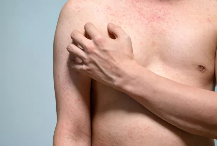 Casos de sarampión en México 2026