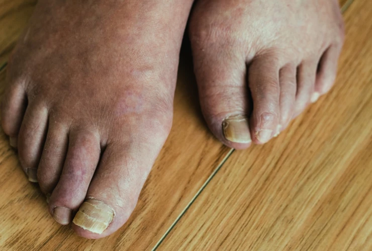 ¿No jugas al futbol y tenés los pies hinchados? Cuidado, puede ser una señal