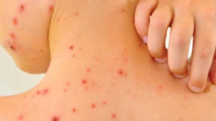 Alarma en EU_ Casos de Sarampión superan los mil en lo que va del 2025; van tres muertes.jpg