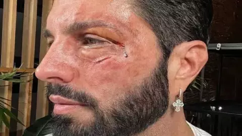 ¿Golpearon a Poncho de Nigris_ La verdad detras de la fotos que preocupó a fans.jpg