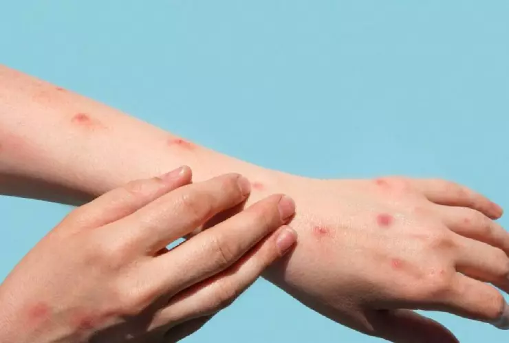 viruela del mono y varicela.jpg