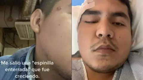 VIDEO Hombre descubre que espinilla en su cara es un tumor.jpg