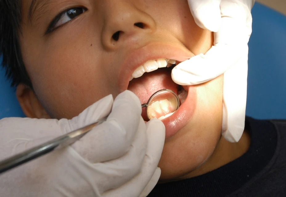 Caries dental