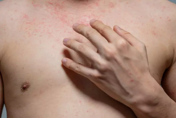 Una persona con sarampión