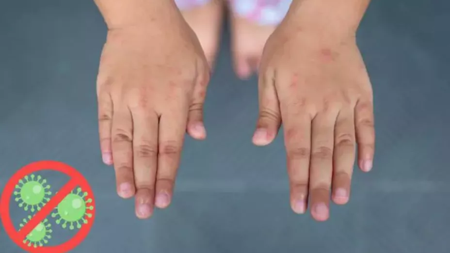 Casos de virus coxsackie en Sinaloa..jpg