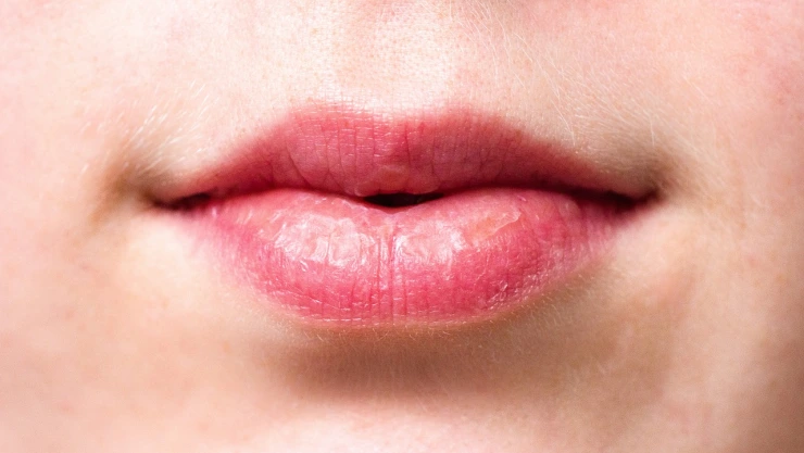 ¿Cómo evitar los labios resecos?